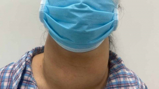 Phẫu thuật thành công khối u tuyến giáp khổng lồ cho 1 nữ bệnh nhân