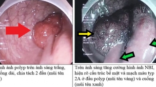 Hy hữu phát hiện 1 trường hợp polyp đại trực tràng có đôi