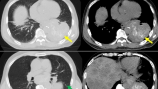 Một nam bệnh nhân phát hiện ung thư phổi trái sau khi sút 5kg trong 2 tuần kèm ho ra máu