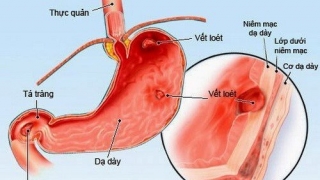 Quảng Ninh: Cảnh báo tình trạng viêm loét dạ dày tá tràng ở độ tuổi là học sinh, sinh viên