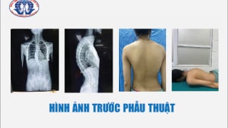 Phú Thọ phẫu thuật nắn chỉnh gù vẹo cột sống cho bệnh nhi 15 tuổi