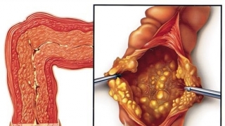 Mối nguy hại từ việc điều trị kháng sinh dài ngày gây viêm đại tràng giả mạc