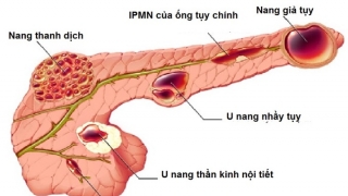 Các biện pháp chẩn đoán viêm nang tụy