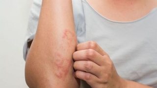 Phơi nắng giảm triệu chứng chàm eczema