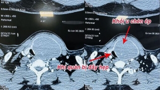 Chuyên gia khuyến cáo không nên chủ quan với u tuyến giáp lành tính