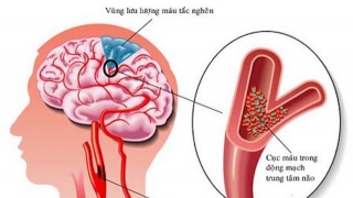 Đề phòng đột quỵ ở người cao tuổi