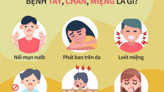 Những triệu chứng điển hình và cách phòng tránh bệnh tay chân miệng