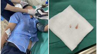 Tuyên Quang nội soi gắp dị vật là xương cá ở thực quản 1 bệnh nhân