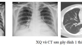 Phú Thọ sử dụng phương pháp gây dính màng phổi bằng bột talc điều trị tràn dịch màng phổi tái diễn