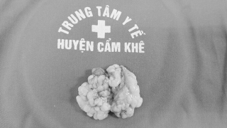 Phú Thọ: Trung tâm Y tế huyện Cẩm Khê phẫu thuật cắt khối u nhú cửa mũi sau bên trái cho bệnh nhân 38 tuổi