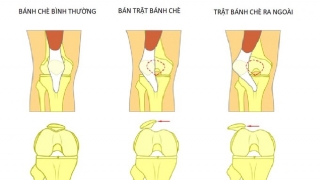 Phẫu thuật, điều trị trật bánh chè sau chấn thương