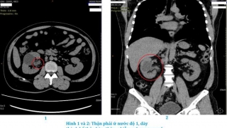 TPHCM: Bệnh viện Chợ Rẫy điều trị cho bệnh nhân 46 tuổi bị lao đường niệu