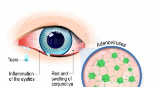 Sở Y tế TPHCM đã xác định được tác nhân gây bệnh đau mắt đỏ