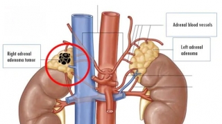 Bệnh viện Hữu Nghị Việt Tiệp Hải Phòng tiếp nhận và điều trị cho 1 trường hợp mắc khối u thượng thận kèm tăng huyết áp