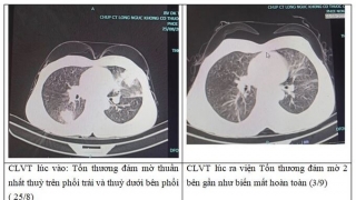 Bệnh viện Đa khoa tỉnh Phú Thọ tiếp nhận 1 nữ bệnh nhân mắc viêm phổi tăng bạch cầu ái toan, không có biểu hiện triệu chứng rõ ràng