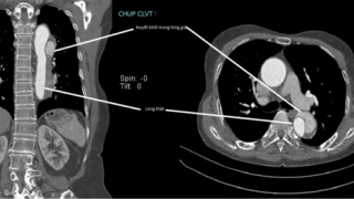 Bệnh viện Đa khoa tỉnh Phú Thọ đặt Stent Graft điều trị thành công bệnh nhân 77 tuổi bị phình tách động mạch chủ