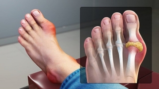 Bệnh gout có xu hướng trẻ hóa, chuyên gia chỉ cách phòng ngừa