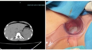 Bệnh viện Đa khoa tỉnh Phú Thọ tiếp nhận 1 bệnh nhi 8 tuổi bị thủng trực tràng do ngồi vào chiếc bút dựng ngược từ trò đùa của bạn