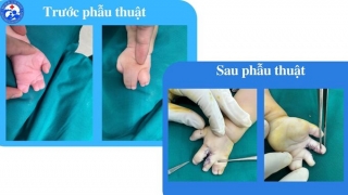 Vĩnh Phúc: Phẫu thuật dính ngón tay thành công cho bệnh nhi 5 tháng tuổi