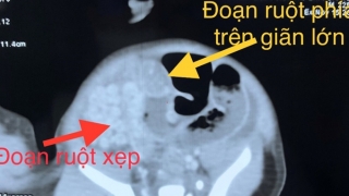 Hải Phòng: Cấp cứu bé sơ sinh bị teo ruột phức tạp