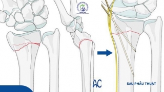 Nghệ An: Phẫu thuật kết hợp xương cho bệnh nhi 9 tuổi bị gãy kín đầu dưới 2 xương cẳng tay