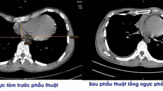 Phú Thọ: Phẫu thuật thành công cho nam bệnh nhân bị lõm ngực suốt 20 năm qua