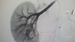 Phú Thọ: Can thiệp nút mạch thành công cho nữ bệnh nhân bị dị dạng thông động tĩnh mạch thận phải