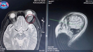 Hải Phòng: Phẫu thuật thành công khối u vùng hốc mắt cho nữ bệnh nhân 69 tuổi