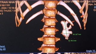 Quảng Nam lấy sỏi thận qua da đường hầm nhỏ cho trường hợp hiếm gặp