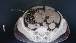 Phú Thọ: Phẫu thuật cấp cứu thành công cho 1 bệnh nhân u đại tràng biến chứng tắc ruột, có nang gan lớn kèm theo
