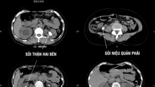 Phú Thọ: Phẫu thuật sỏi niệu quản và sỏi thận 2 bên cùng lúc cho 1 bệnh nhân 49 tuổi