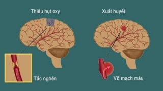 Cảnh báo nguy cơ đột quỵ khi thời tiết chuyển lạnh