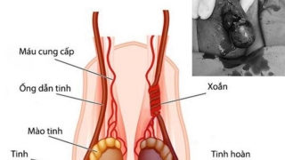 Cao Bằng: Phẫu thuật cho bệnh nhân 14 tuổi bị xoắn tinh hoàn