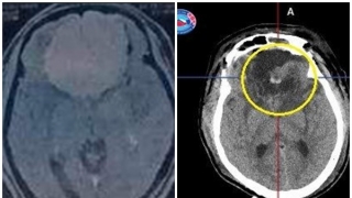 Hải Phòng: Thực hiện thành công ca phẫu thuật u màng não có kích thước khổng lồ cho bệnh nhân 62 tuổi
