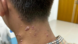 Đồng Nai ghi nhận thêm một ca nghi mắc đậu mùa khỉ