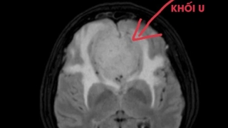 Phú Thọ: 2 trường hợp bệnh nhân đến khám với triệu chứng mờ mắt nhưng phát hiện khối u não lớn
