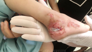 Quảng Ninh xử lý vết thương bị kẹp gót chân phải vào nan hoa xe đạp cho bé trai 5 tuổi