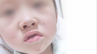 Lào Cai: Gắp thành công con vắt dài gần 10 cm sống 2 tháng trong mũi bé trai 4 tuổi