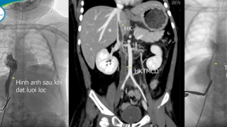 Bé trai 5 tuổi mắc thận hư kháng steroid rơi vào nguy kịch do tự ý bỏ thuốc với biến chứng huyết khối toàn bộ tĩnh mạch lớn