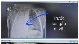 TP. Hồ Chí Minh: Nội soi gắp thành công dị vật cuống xoài trong đường thở do trẻ bị hóc sặc trong lúc ăn dặm