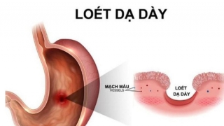 Những dấu hiệu thầm lặng cảnh báo loét dạ dày