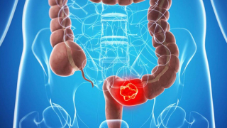 Vĩnh Phúc: 3 người trong 1 gia đình đều mắc ung thư đại tràng