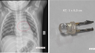 Quảng Ninh: Gắp bóng đèn trong đường thở của bệnh nhi 10 tháng tuổi