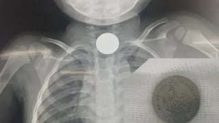 Đồng Nai: Nội soi gắp đồng xu kim loại có kích thước 20mm ra khỏi thực quản bệnh nhi 3 tuổi