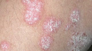 Điều trị cho bệnh nhân nữ bị vảy nến kèm theo tình trạng trầm cảm, tâm thần phân liệt