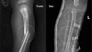 Phú Thọ: Ngã lọt chân vào khe hở cống thoát nước, bé trai 3 tuổi bị gãy hoàn toàn 2 xương cẳng chân