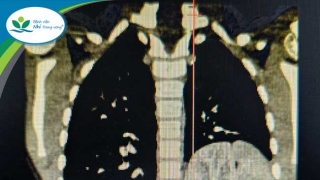 Hà Nội: Phẫu thuật thành công cho bé trai 6 tuổi bị thoát vị hoành bẩm sinh kèm theo thận lạc chỗ trên lồng ngực và phổi biệt lập