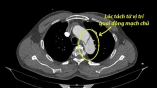 Phú Thọ: Áp dụng kỹ thuật Hybrid cứu sống người bệnh nặng do lóc tách động mạch chủ ngực