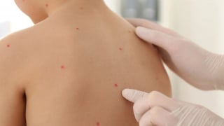Đắk Lắk: Ghi nhận ổ dịch thủy đậu tại trường học