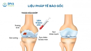 Đau hơn sau khi tiêm tế bào gốc trong điều trị thoái hóa khớp: Điều bình thường và cách xử lý